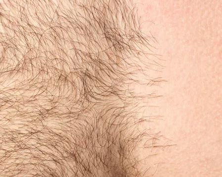 Hair Removal image